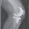 WRF knee replacent side small cropped.jpg